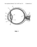OCULAR IMPLANTS WITH DEPLOYABLE STRUCTURE diagram and image