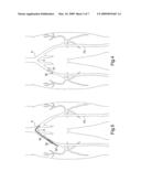 Method and apparatus for conducting peripheral vascular disease procedures using a novel anchor balloon catheter diagram and image