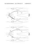 Method and apparatus for conducting peripheral vascular disease procedures using a novel anchor balloon catheter diagram and image