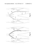 Method and apparatus for conducting peripheral vascular disease procedures using a novel anchor balloon catheter diagram and image