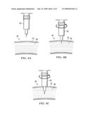 SYSTEM AND METHOD FOR PROVIDING AN OBTURATOR FOR ENHANCED DIRECTIONAL CAPABILITIES IN A VASCULAR ENVIRONMENT diagram and image