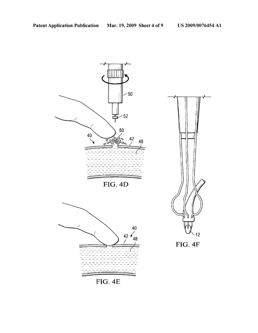 SYSTEM AND METHOD FOR PROVIDING AN OBTURATOR FOR ENHANCED DIRECTIONAL CAPABILITIES IN A VASCULAR ENVIRONMENT - diagram, schematic, and image 05