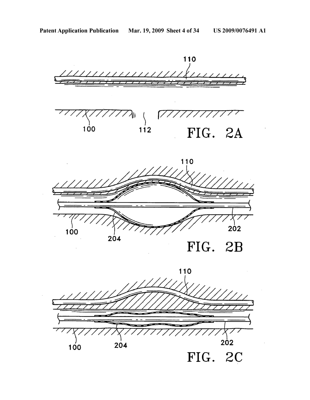 METHODS FOR MAINTAINING THE PATENCY OF COLLATERAL CHANNELS IN THE LUNGS USING CRYO-ENERGY - diagram, schematic, and image 05