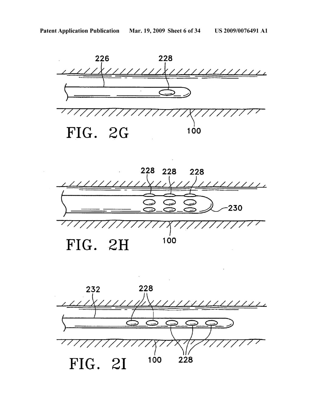 METHODS FOR MAINTAINING THE PATENCY OF COLLATERAL CHANNELS IN THE LUNGS USING CRYO-ENERGY - diagram, schematic, and image 07