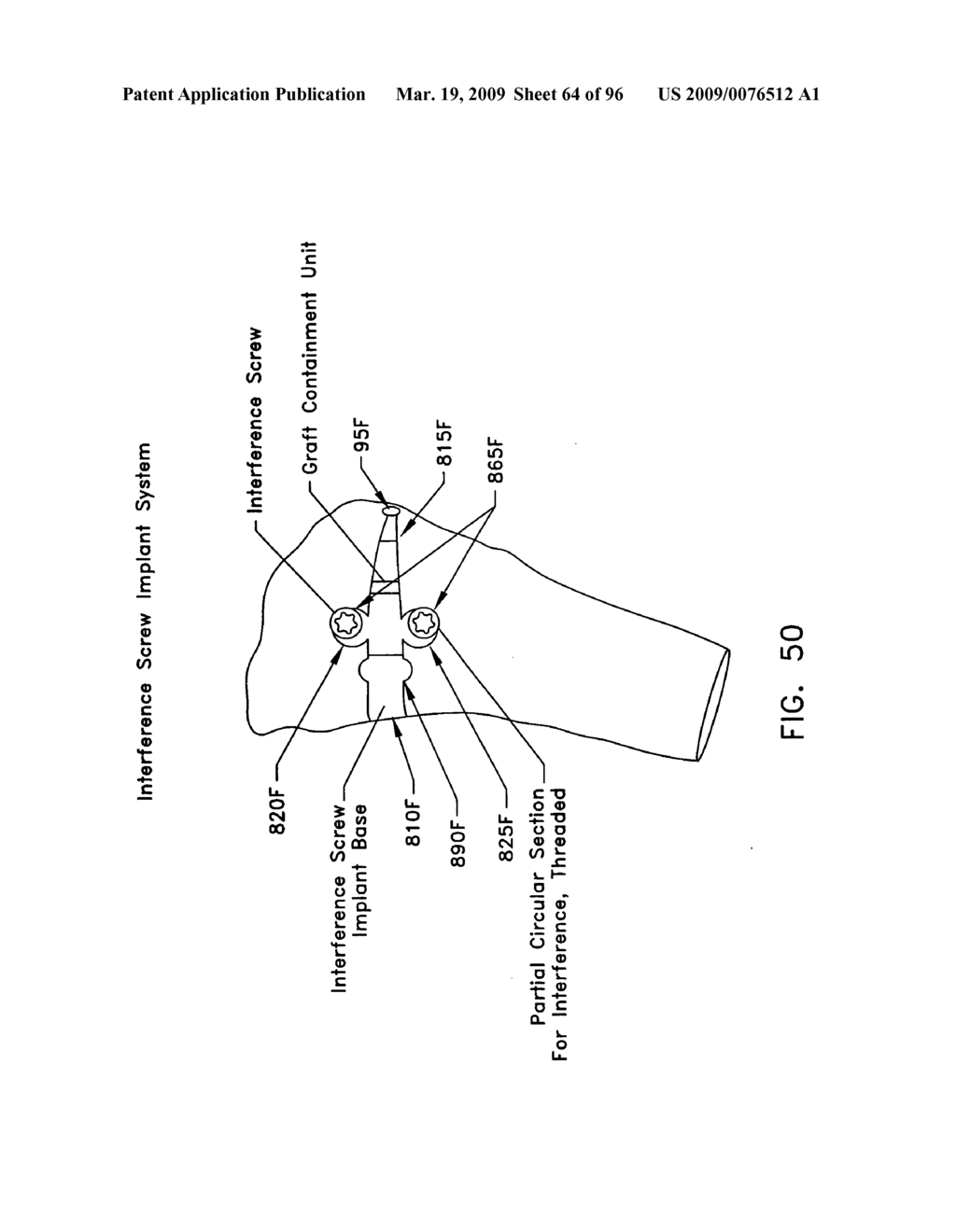 Method and apparatus for reconstructing a ligament and/or repairing cartilage, and for performing an open wedge, high tibial osteotomy - diagram, schematic, and image 65