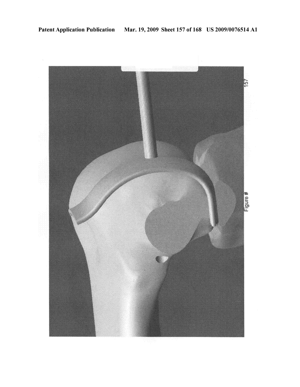 Methods and apparatus for improved profile based resection - diagram, schematic, and image 158