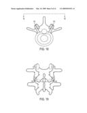 METHODS AND SURGICAL KITS FOR MINIMALLY-INVASIVE FACET JOINT FUSION diagram and image