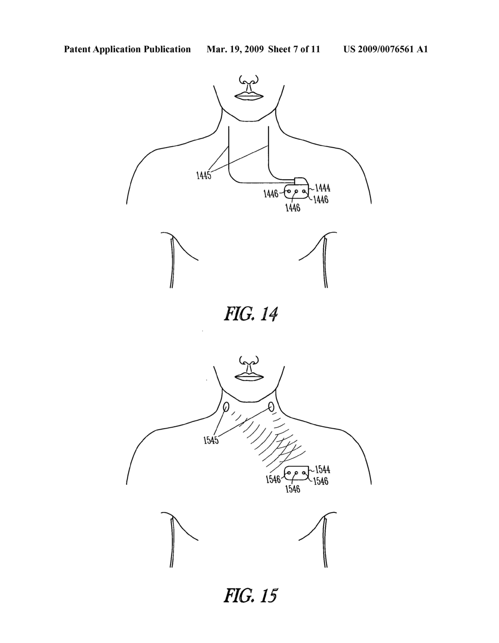 Systems and methods for avoiding neural stimulation habituation - diagram, schematic, and image 08