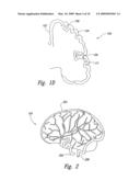 Electrode Configurations for Reducing Invasiveness and/or Enhancing Neural Stimulation Efficacy, and Associated Methods diagram and image