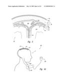 Electrode Configurations for Reducing Invasiveness and/or Enhancing Neural Stimulation Efficacy, and Associated Methods diagram and image