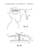 Electrode Configurations for Reducing Invasiveness and/or Enhancing Neural Stimulation Efficacy, and Associated Methods diagram and image