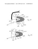 Medical device suitable for use in treatment of a valve diagram and image