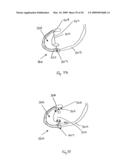 Medical device suitable for use in treatment of a valve diagram and image