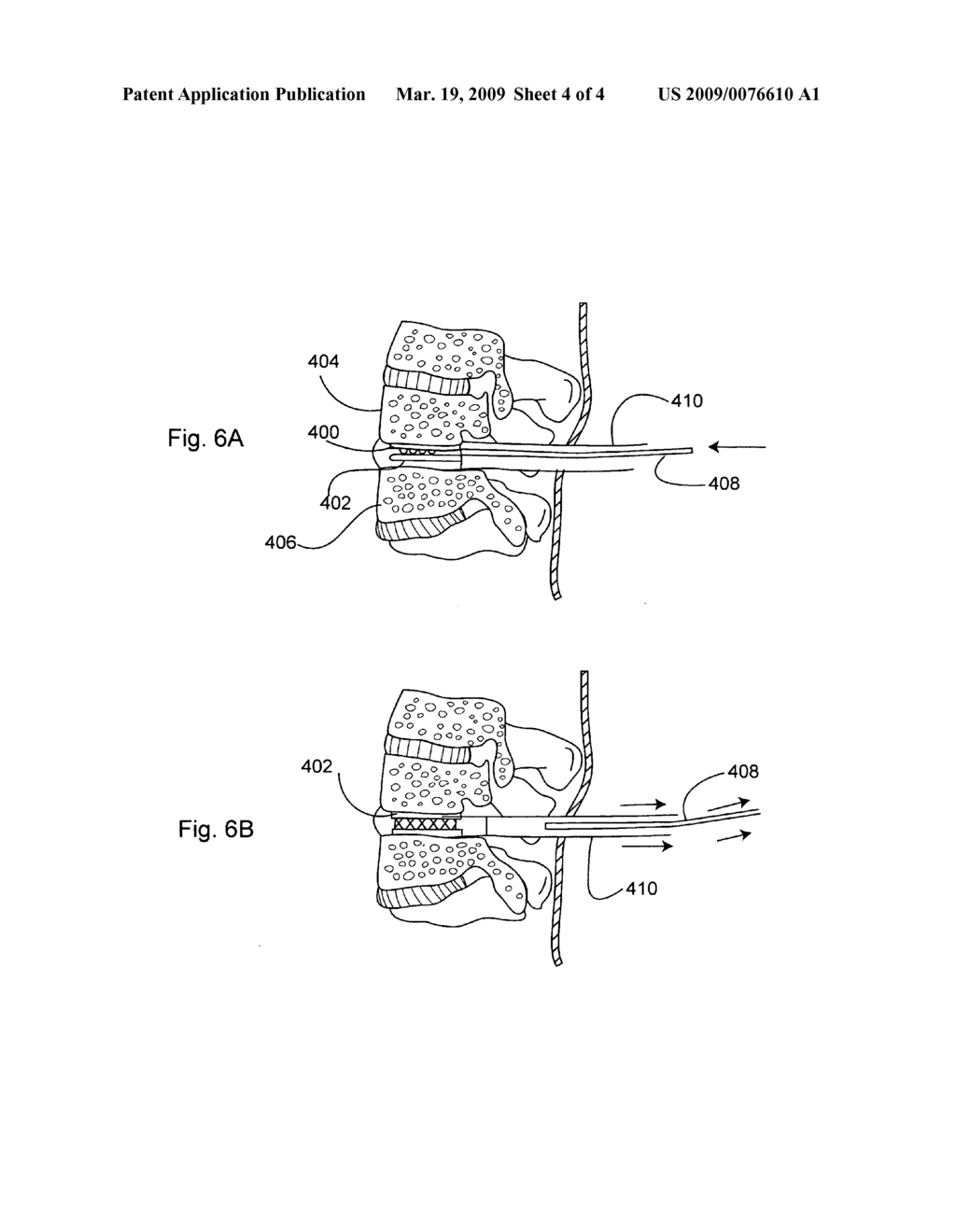 Prosthetic Intervertebral Discs Having Balloon-Based Fillable Cores That are Implantable By Minimally Invasive Surgical Techniques - diagram, schematic, and image 05