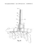 Systems and Methods for Vertebral Disc Replacement diagram and image