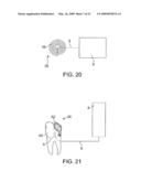 Implantable Obstructive Sleep Apnea Sensor diagram and image