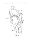 Implantable Obstructive Sleep Apnea Sensor diagram and image