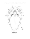 Implantable Obstructive Sleep Apnea Sensor diagram and image