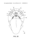 Implantable Obstructive Sleep Apnea Sensor diagram and image