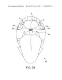 Implantable Obstructive Sleep Apnea Sensor diagram and image