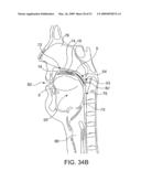 Implantable Obstructive Sleep Apnea Sensor diagram and image