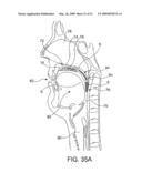 Implantable Obstructive Sleep Apnea Sensor diagram and image