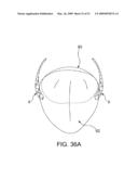 Implantable Obstructive Sleep Apnea Sensor diagram and image