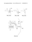 Implantable Obstructive Sleep Apnea Sensor diagram and image