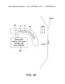 Implantable Obstructive Sleep Apnea Sensor diagram and image