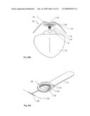 Implantable Obstructive Sleep Apnea Sensor diagram and image