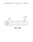 Implantable Obstructive Sleep Apnea Sensor diagram and image