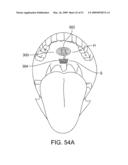 Implantable Obstructive Sleep Apnea Sensor diagram and image