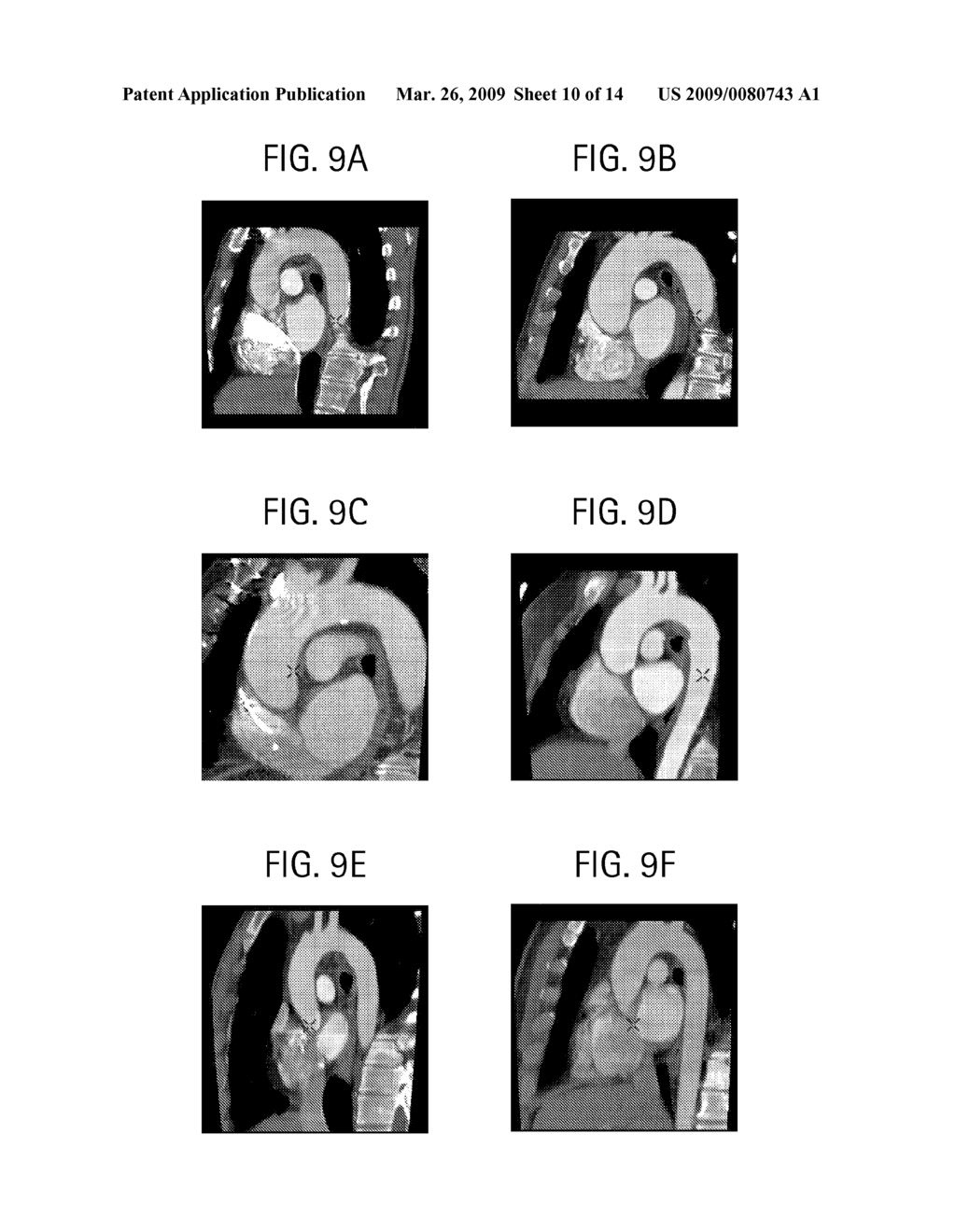 METHOD TO DETECT THE AORTIC ARCH IN CT DATASETS FOR DEFINING A HEART WINDOW - diagram, schematic, and image 11