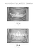 SYSTEM AND METHOD FOR IMMEDIATE LOADING OF FIXED HYBRID DENTAL PROSTHESES diagram and image