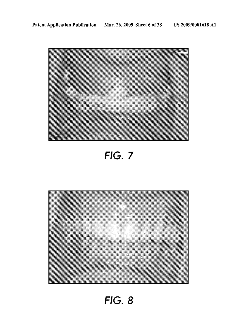 SYSTEM AND METHOD FOR IMMEDIATE LOADING OF FIXED HYBRID DENTAL PROSTHESES - diagram, schematic, and image 07