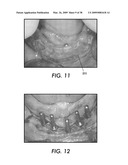 SYSTEM AND METHOD FOR IMMEDIATE LOADING OF FIXED HYBRID DENTAL PROSTHESES diagram and image