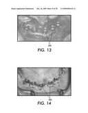 SYSTEM AND METHOD FOR IMMEDIATE LOADING OF FIXED HYBRID DENTAL PROSTHESES diagram and image