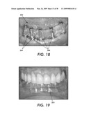 SYSTEM AND METHOD FOR IMMEDIATE LOADING OF FIXED HYBRID DENTAL PROSTHESES diagram and image