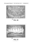 SYSTEM AND METHOD FOR IMMEDIATE LOADING OF FIXED HYBRID DENTAL PROSTHESES diagram and image