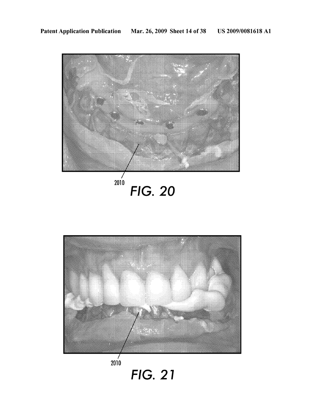 SYSTEM AND METHOD FOR IMMEDIATE LOADING OF FIXED HYBRID DENTAL PROSTHESES - diagram, schematic, and image 15