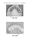 SYSTEM AND METHOD FOR IMMEDIATE LOADING OF FIXED HYBRID DENTAL PROSTHESES diagram and image