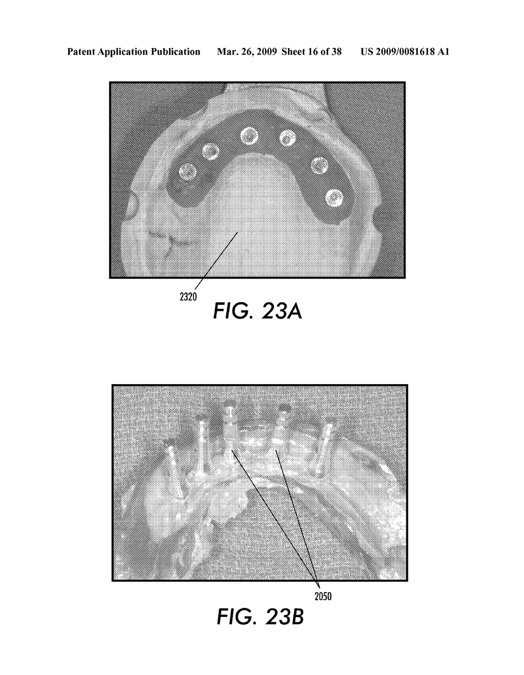 SYSTEM AND METHOD FOR IMMEDIATE LOADING OF FIXED HYBRID DENTAL PROSTHESES - diagram, schematic, and image 17