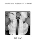 SYSTEM AND METHOD FOR IMMEDIATE LOADING OF FIXED HYBRID DENTAL PROSTHESES diagram and image