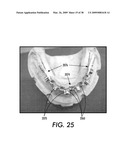 SYSTEM AND METHOD FOR IMMEDIATE LOADING OF FIXED HYBRID DENTAL PROSTHESES diagram and image