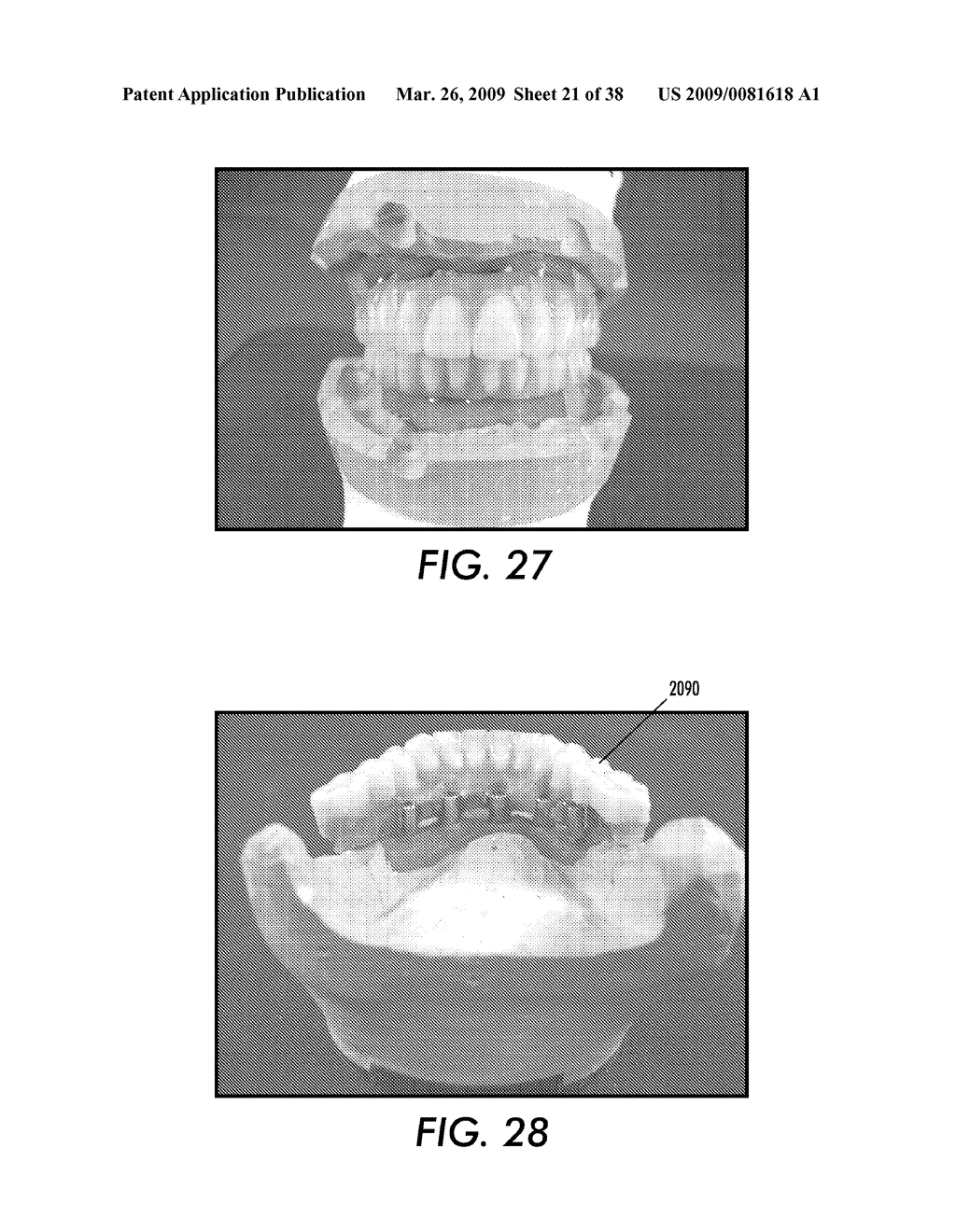 SYSTEM AND METHOD FOR IMMEDIATE LOADING OF FIXED HYBRID DENTAL PROSTHESES - diagram, schematic, and image 22