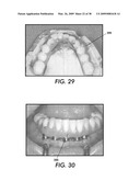 SYSTEM AND METHOD FOR IMMEDIATE LOADING OF FIXED HYBRID DENTAL PROSTHESES diagram and image