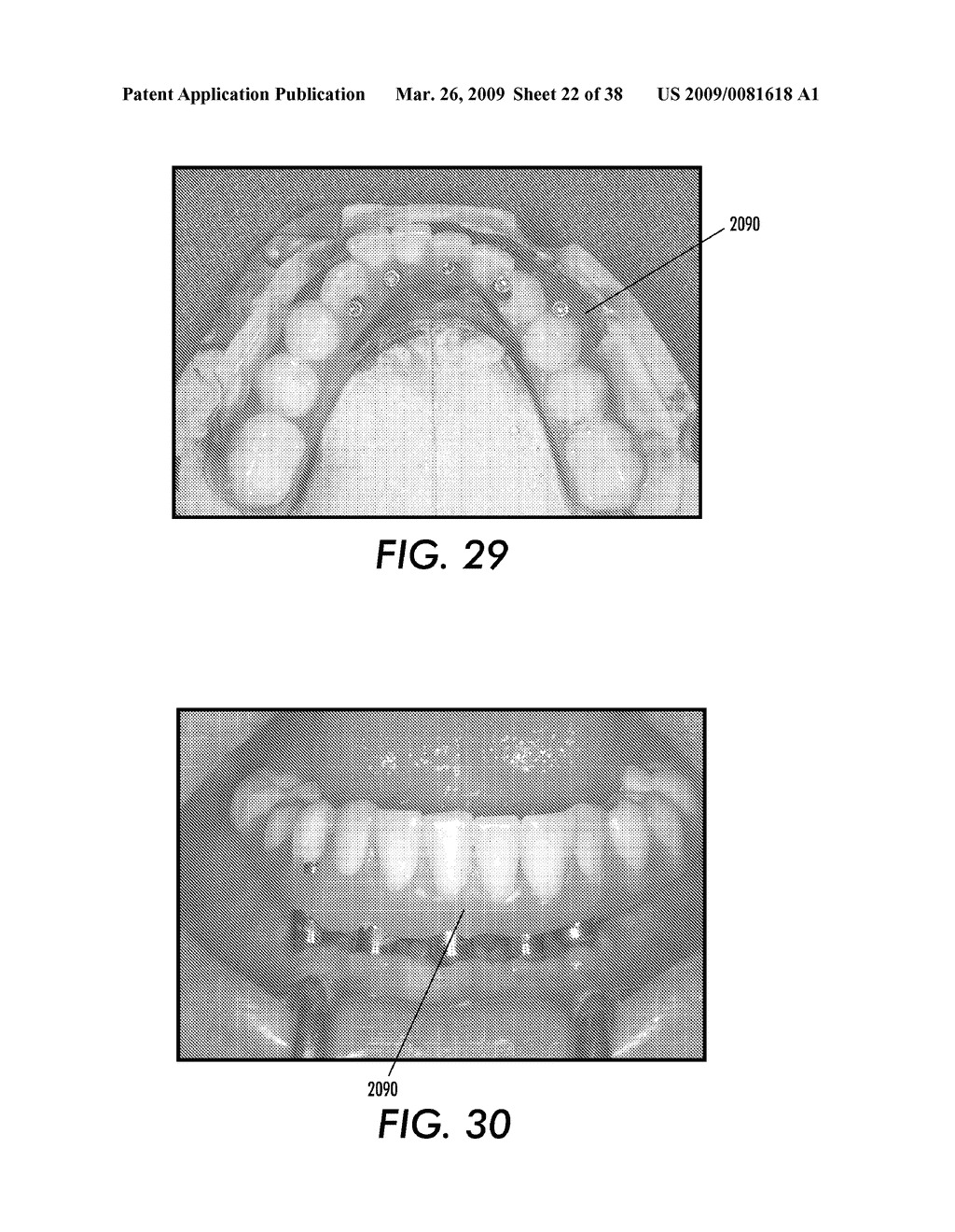 SYSTEM AND METHOD FOR IMMEDIATE LOADING OF FIXED HYBRID DENTAL PROSTHESES - diagram, schematic, and image 23