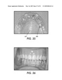 SYSTEM AND METHOD FOR IMMEDIATE LOADING OF FIXED HYBRID DENTAL PROSTHESES diagram and image