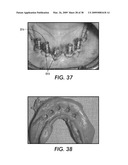 SYSTEM AND METHOD FOR IMMEDIATE LOADING OF FIXED HYBRID DENTAL PROSTHESES diagram and image