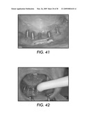 SYSTEM AND METHOD FOR IMMEDIATE LOADING OF FIXED HYBRID DENTAL PROSTHESES diagram and image